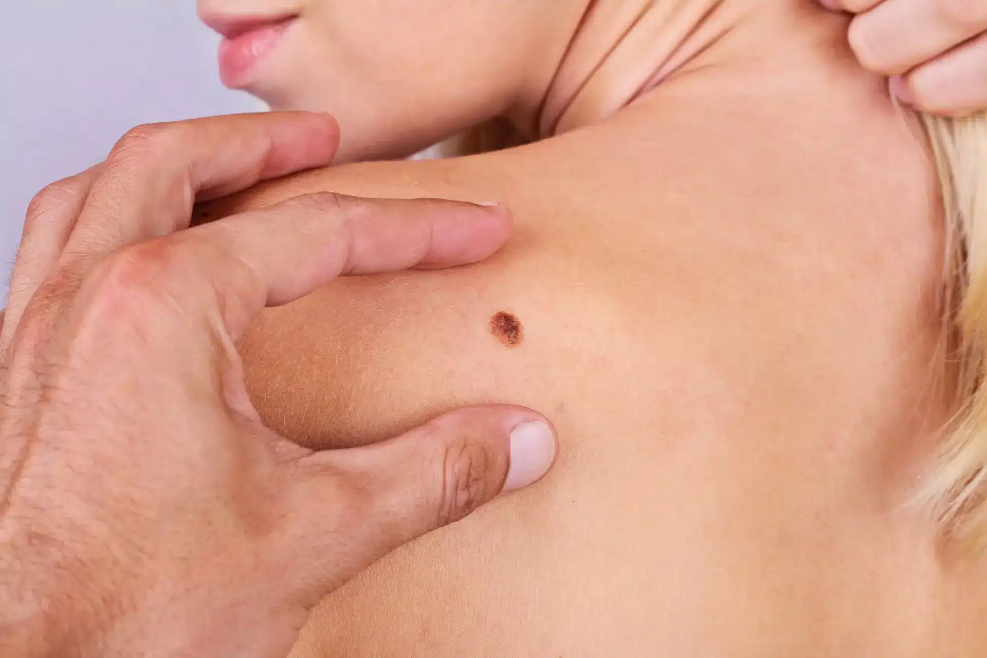 Skin doctor Hervey Bay